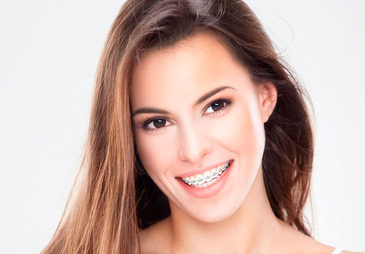 Brackets estético ortodoncia en Instituto dental facial