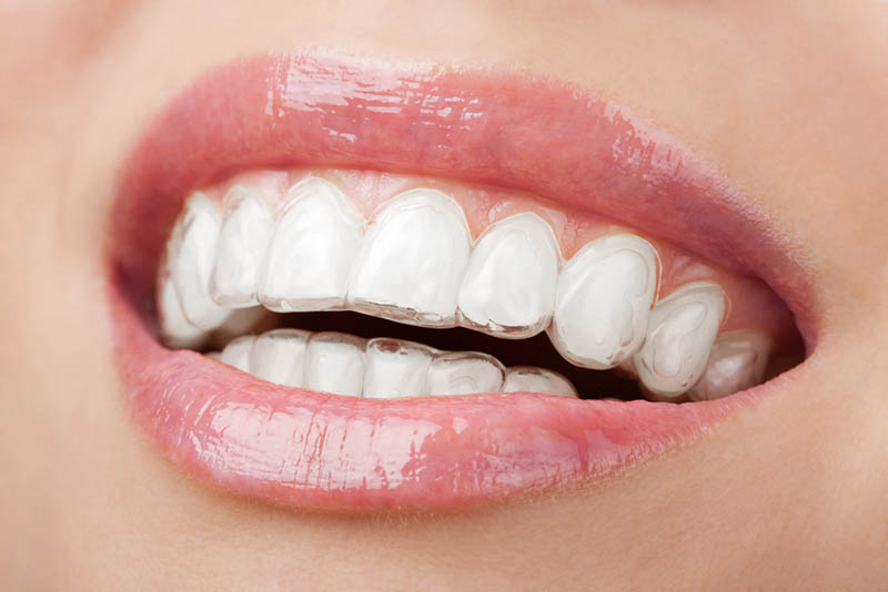 Ortodoncia Invisible: Invisalign