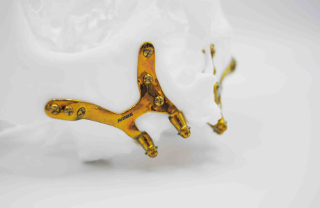 ¿Implantes dentales sin tornillos? -   