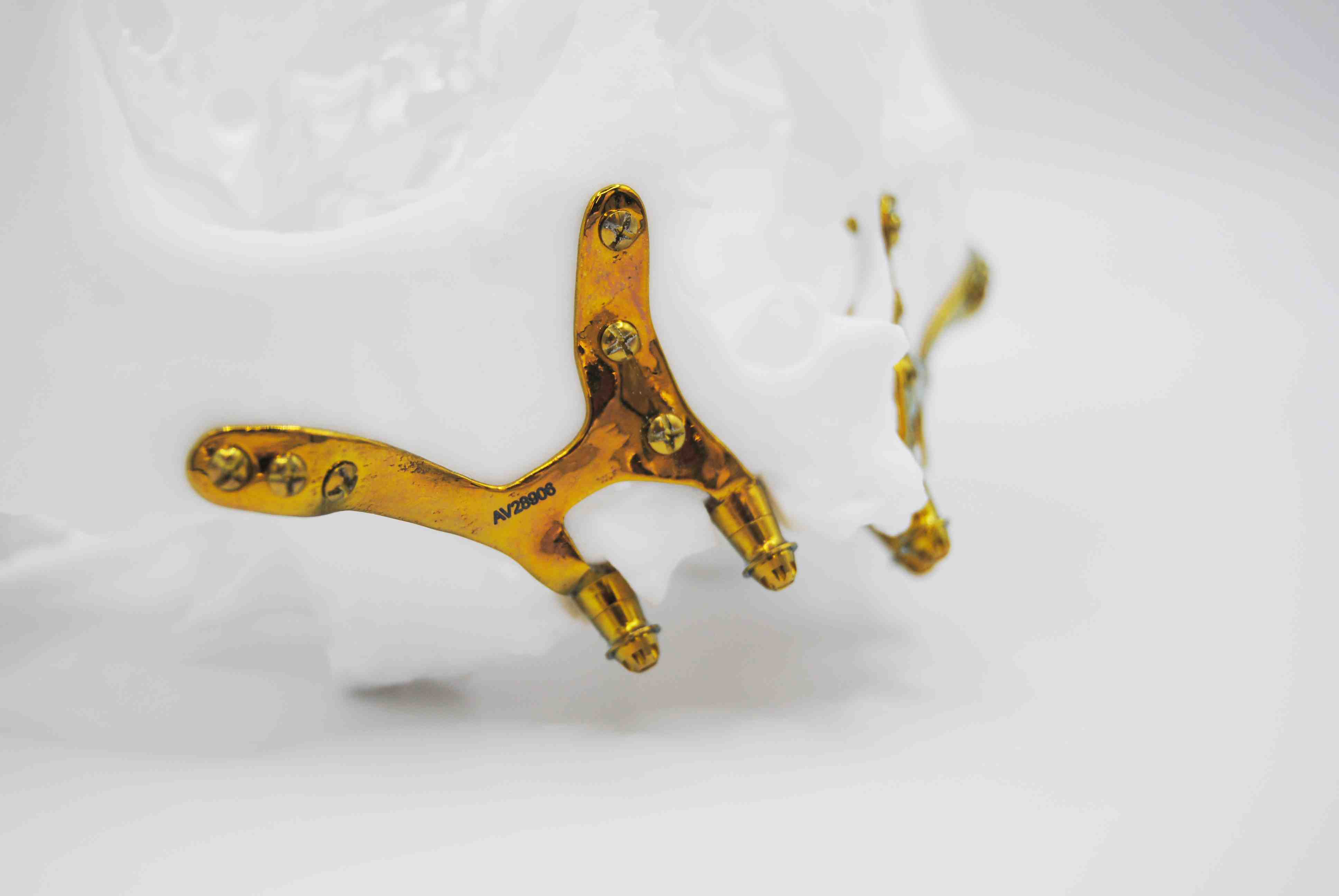 Implantes sin tornillos subperiósticos. Prótesis dental fija sin injertos